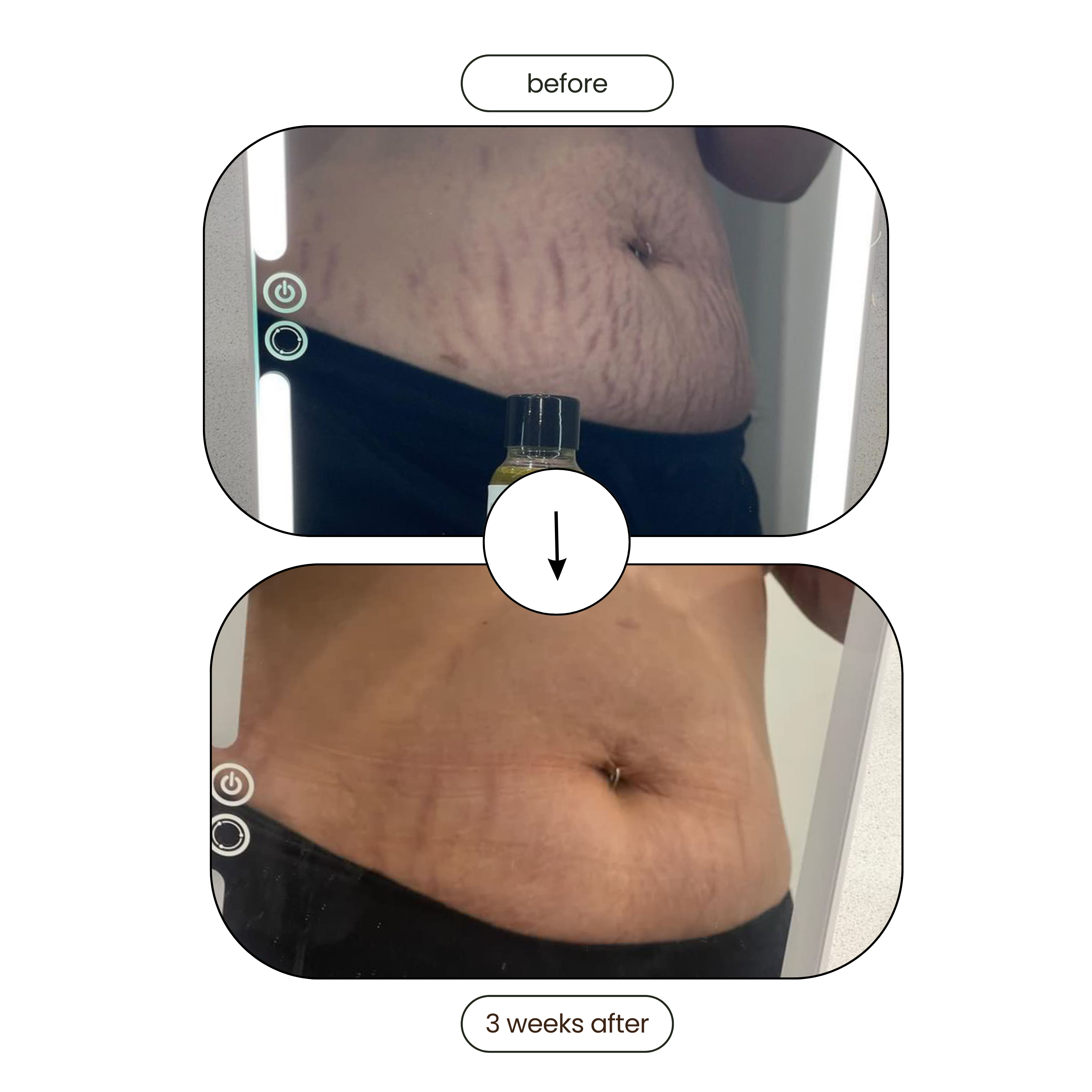 Meiskin Stretch Mark and Scar Removal Oil