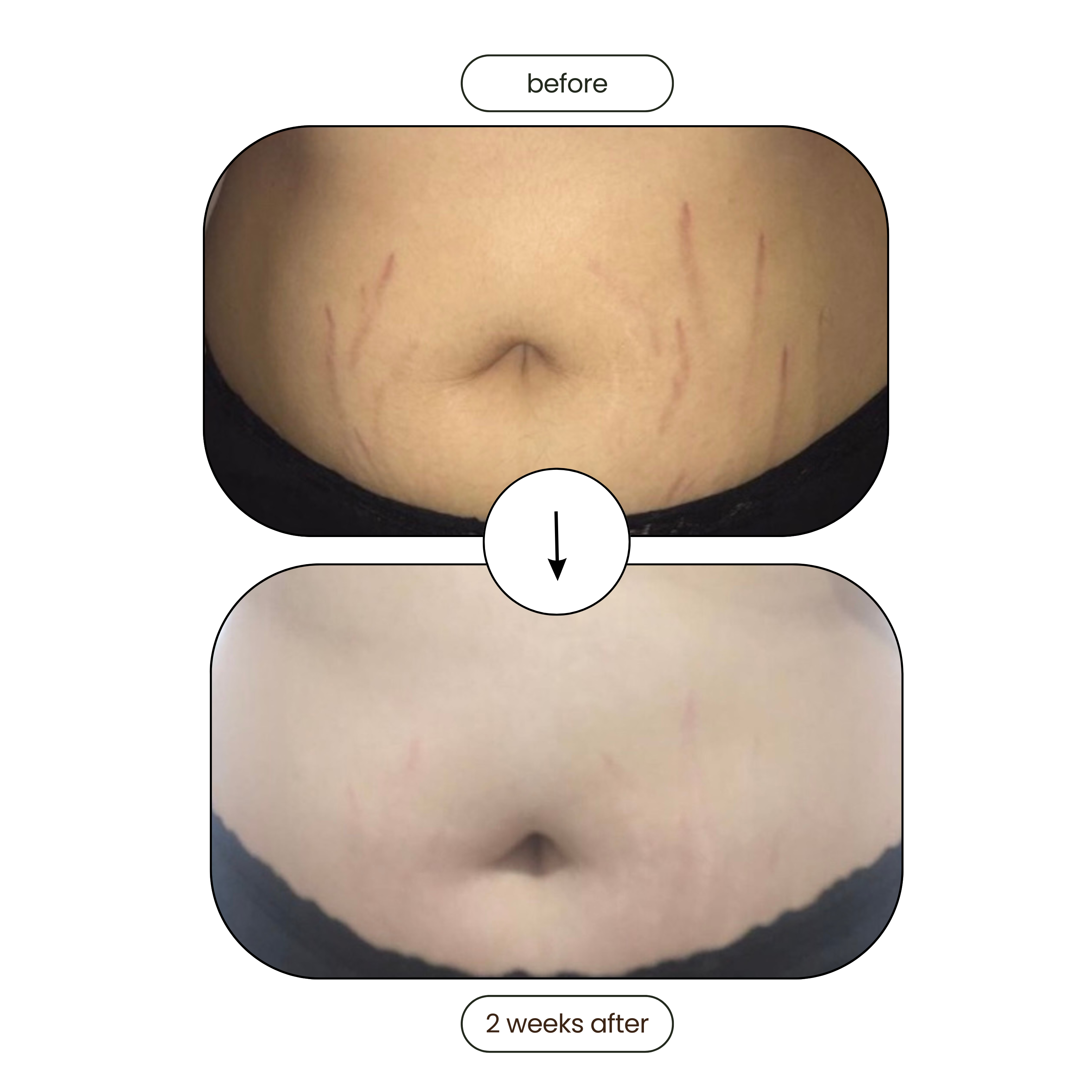 Meiskin Stretch Mark and Scar Removal Oil