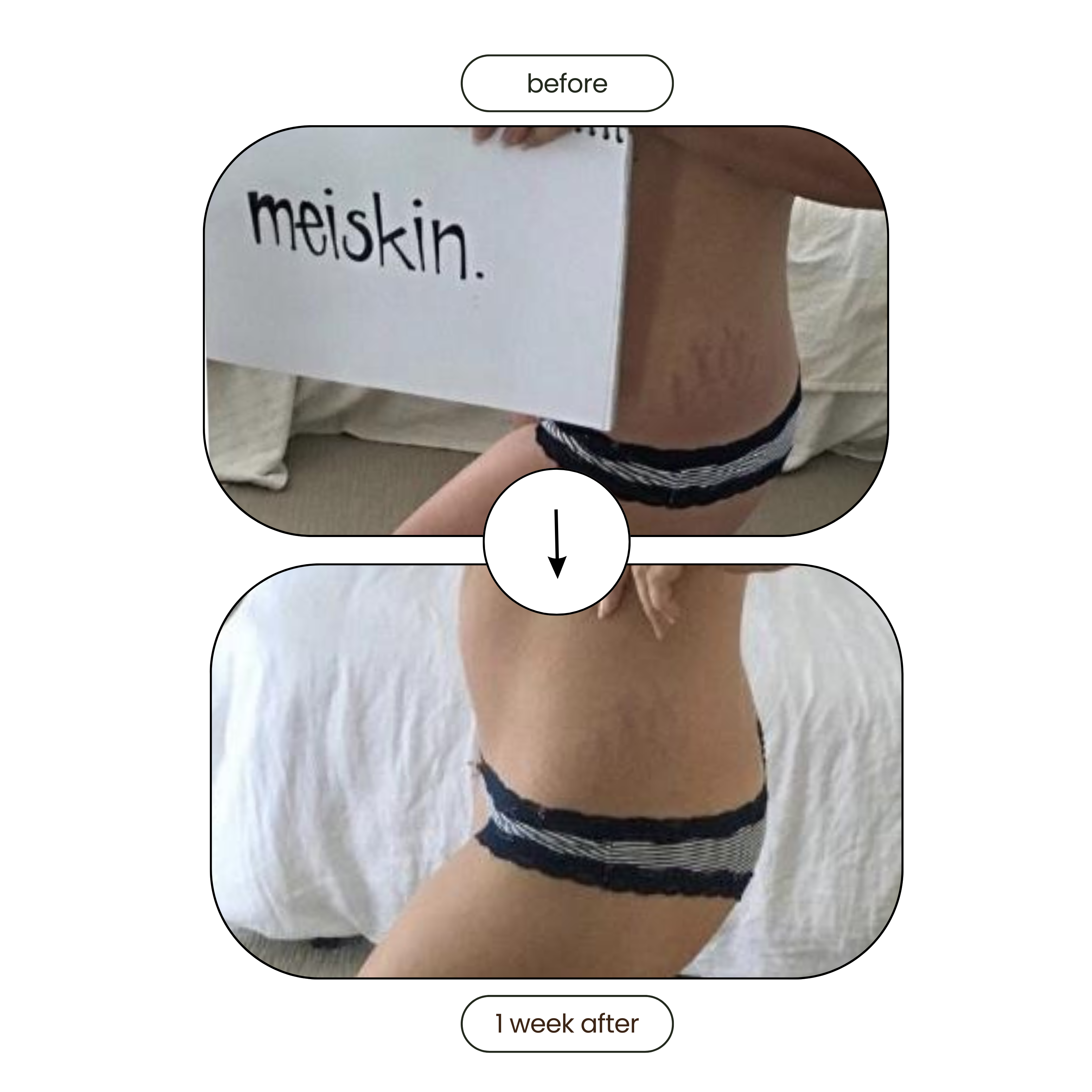 Meiskin Stretch Mark and Scar Removal Oil