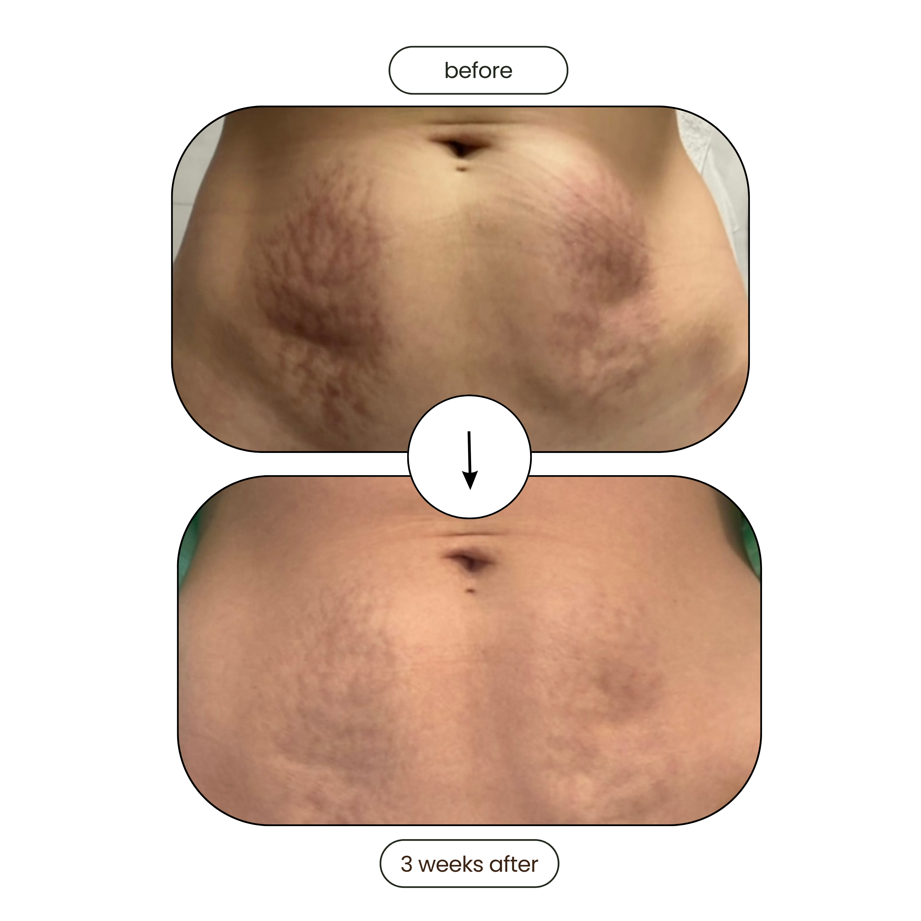 Meiskin Stretch Mark and Scar Removal Oil